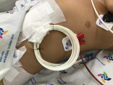 Uống nhầm hóa chất trong chai nước, bé trai 2,5 tuổi phải nhập viện cấp cứu