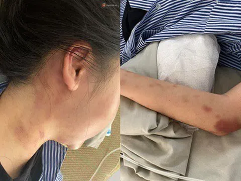 Cử lực lượng đảm bảo an toàn cô gái bị đánh đập suốt 2 giờ ở Yên Bái