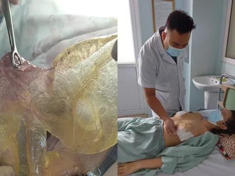 Hà Nội: Bị vỡ túi ngực sau 6 năm phẫu thuật