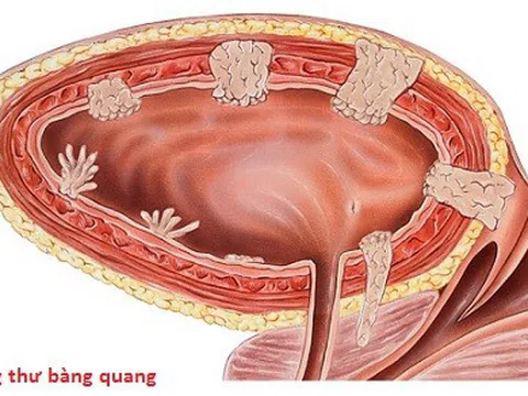 Đau vùng hông thắt lưng chớ có chủ quan bởi đây có thể là dấu hiệu  của ung thư bàng quang