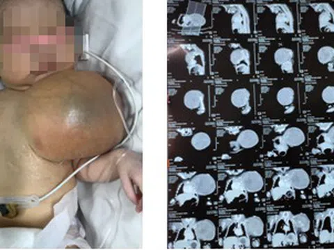 Thành công cắt bỏ khối u "khổng lồ" ở ngực cho bé 3 ngày tuổi