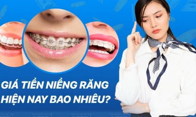 Giá niềng năng hiện nay bao nhiêu và được tính như thế nào?