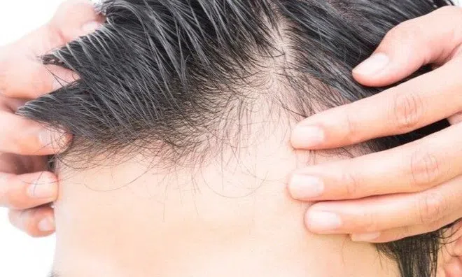 "Tự sướng" nhiều có thể gây hói đầu? Chuyên gia tình dục tiết lộ điều này mới đáng lo