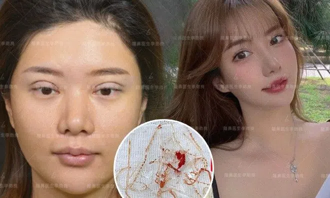 Muốn đẹp nhưng không đụng "dao kéo", cô gái xỏ 16 sợi chỉ vào mũi và cái kết đau đớn