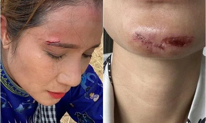 Tai nạn ở trường quay gameshow: Hoa hậu hoảng loạn bị flycam đập vào mặt, Vũ Hà rách da đầu chảy máu