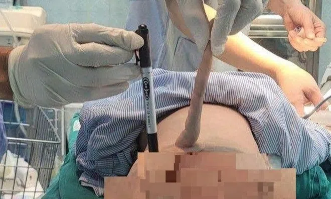 Bé trai 4 tháng tuổi ở Thanh Hóa có đuôi dài 14cm