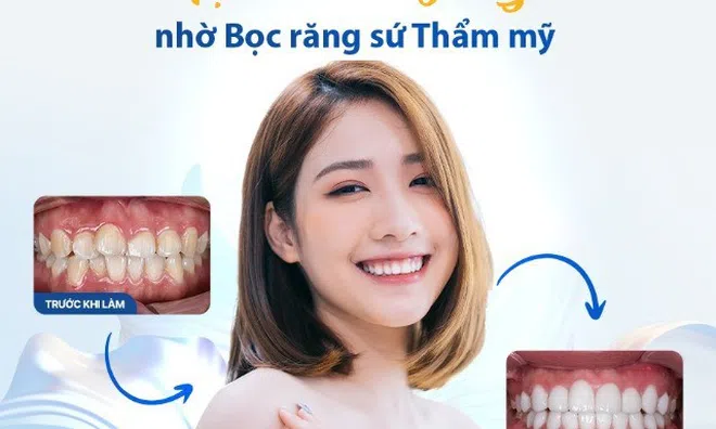Nha khoa ViDental bọc răng sứ bền đẹp, trắng sáng tự nhiên