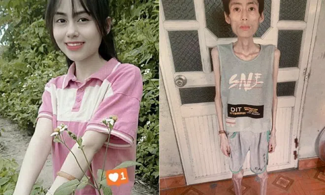 Cô gái Hưng Yên nặng 18kg sau nhiều năm bỏ ăn cơm để giảm cân, bác sĩ cảnh báo: Đừng khuyên nhau cắt tinh bột!