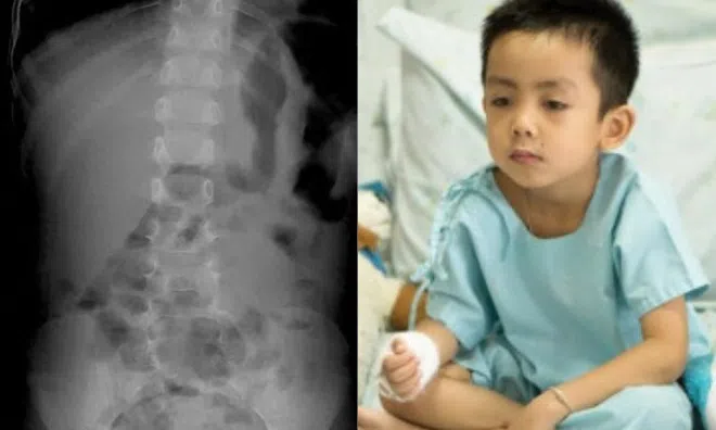 Sau bữa ăn tất niên ở nhà, bé 6 tuổi nôn mửa khiến bố mẹ thất kinh đưa vào viện, bác sĩ bật cười