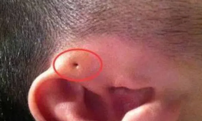 Mẹ phát hiện gần tai con xuất hiện một lỗ sâu khác thường liền tò mò bóp thử, không ngờ bác sĩ yêu cầu phẫu thuật ngay