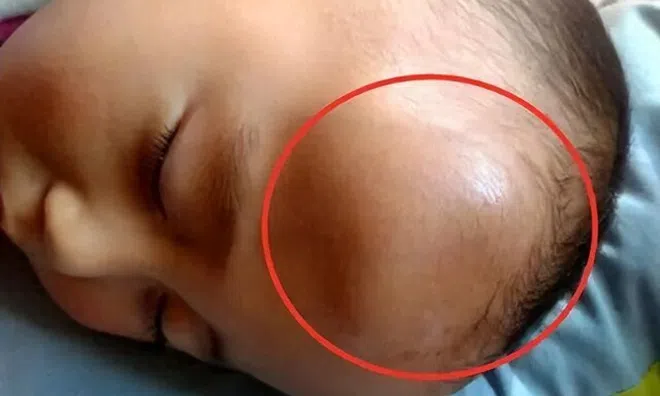 Bé 1 tuổi ngã, trên đầu hiện khối u lớn, cách xử lý của người mẹ bất ngờ nhận lời khen từ bác sĩ