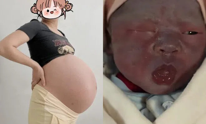 Bà bầu mang thai 33 tuần bị đau lưng, bác sĩ hoảng hốt khám: "Phẫu thuật ngay, nếu không cả mẹ và con đều khó sống"