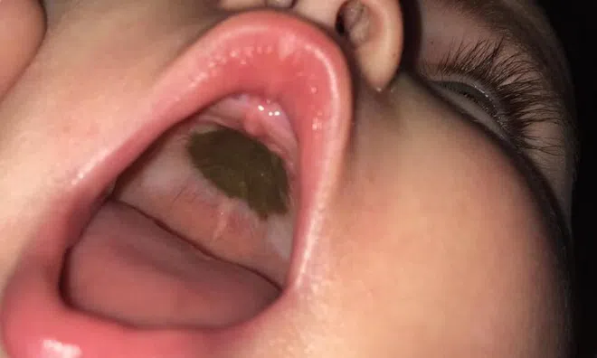 Mẹ phát hoảng thấy miệng con xuất hiện đốm đen lạ, đến bệnh viện nghe bác sĩ chúc mừng mà xấu hổ