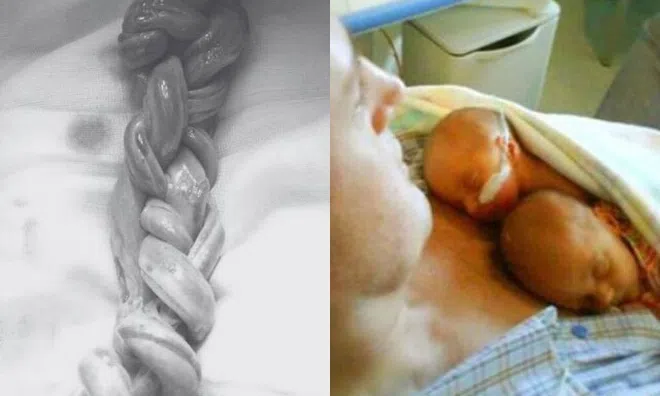 Cặp sinh đôi mắc bệnh hiếm, hai dây rốn đan nhau như tết tóc vẫn sống sót kỳ diệu, chào đời cực xinh