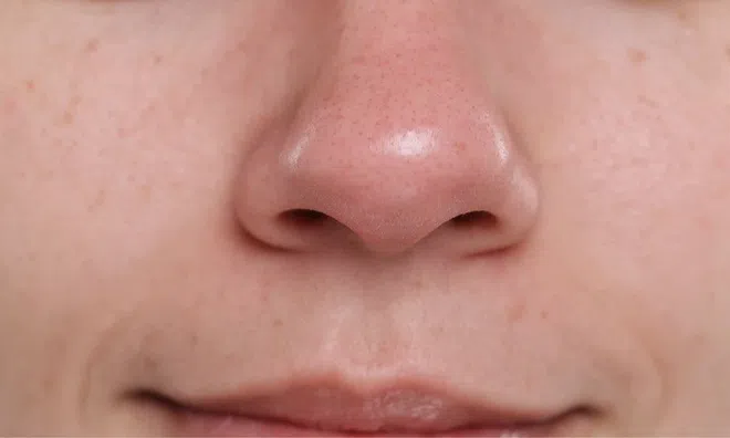 Mụn đầu đen tái đi tái lại dù chăm da kỹ? Nguyên nhân có thể nằm ở những thói quen hằng ngày của bạn