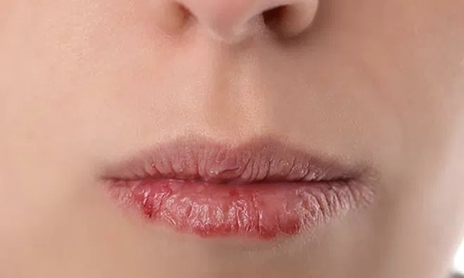 Muốn có một đôi môi hồng hào, căng mọng bạn hãy dừng lại ngay những thói quen này