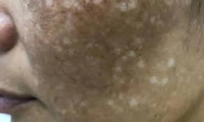 Đun nước lá trị nám theo Tiktok, 4 phụ nữ mặt loang lổ sau một đêm