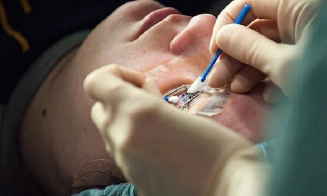 Mổ mắt cận thị có được hưởng bảo hiểm y tế?