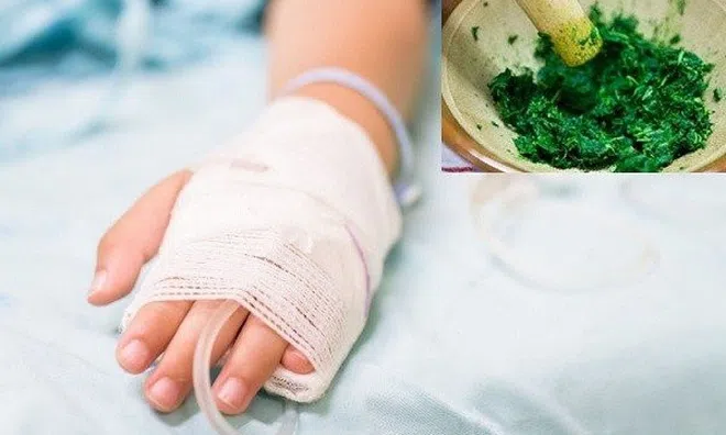 Cháu bé 14 tuổi hoại tử ngón tay do tự ý đắp thuốc lá của thầy lang