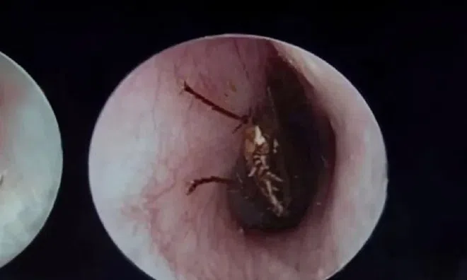 Bé bị gián bò vào tai, mẹ xử lý cách này được bác sĩ khen ngợi hết lời