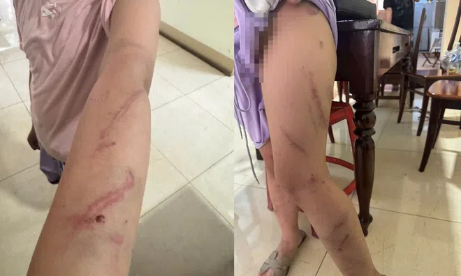 Cha đưa con gái 9 tuổi đến trình báo công an, sau khi phát hiện 34 vết bầm trên cơ thể con