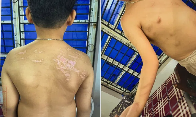 Khởi tố người cha đánh con ruột gây thương tích 36% ở Phú Thọ