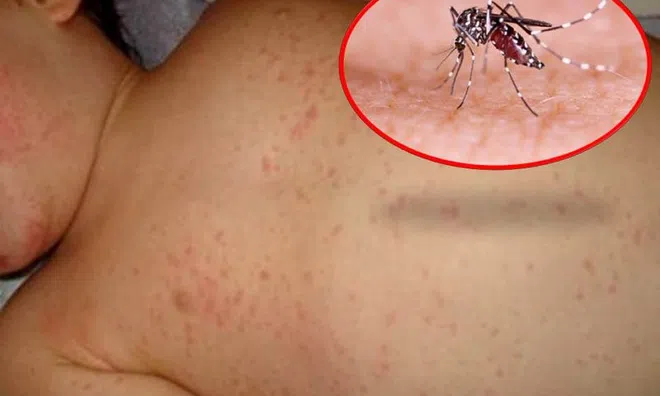 Ca mắc sốt xuất huyết tăng 148%, 34 người tử vong