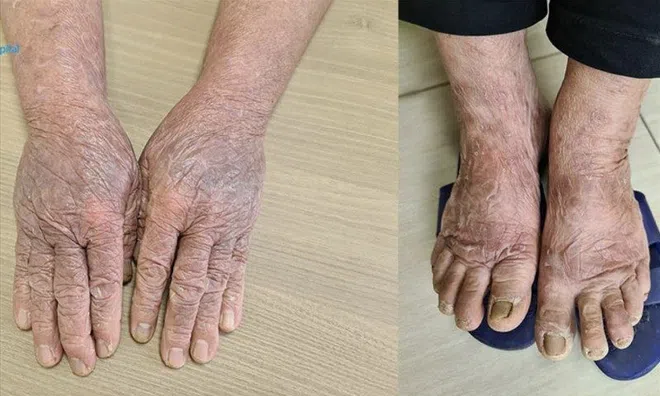 Cụ bà 73 tuổi mẩn đỏ toàn thân, nhiễm trùng do dị ứng thuốc nhuộm tóc