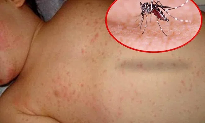 Số ca sốt xuất huyết tại Hà Nội tăng dựng đứng, lên hơn 2.000 ca/tuần