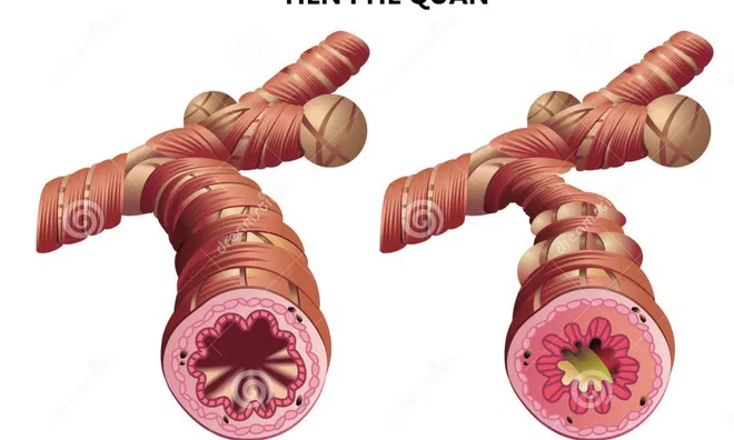 Hen suyễn ảnh hưởng lớn tới tình dục