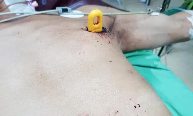 Cứu sống người đàn ông 48 tuổi bị dao đâm thủng tim, gan