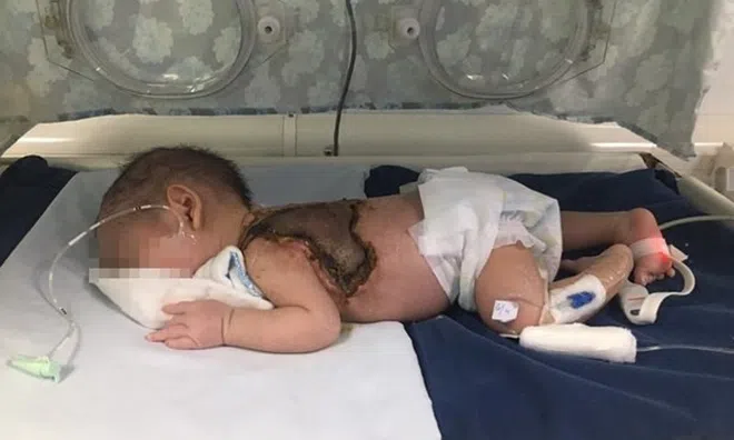 Người nhà dùng kim khâu chích mụn, bé sơ sinh 15 ngày tuổi bị hoại tử da, nhiễm trùng máu