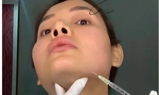 Phương Trinh Jolie gây "sốc" khi chia sẻ hình ảnh tự tay tiêm filler lên mặt