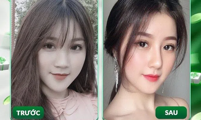 Tín đồ thẩm mỹ “chết mê” với công nghệ nâng mũi mới giúp lành thương cực nhanh