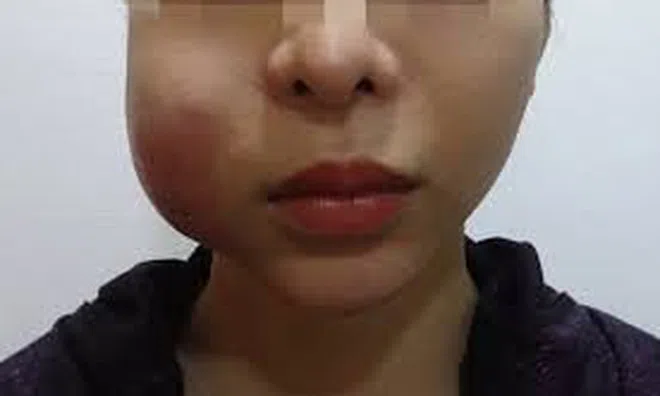 Tiêm filler hết 40 triệu đồng, cô gái trẻ bị hoại tử đến biến dạng mặt