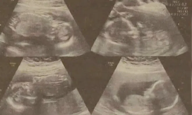 Cô gái sinh 2 con cách nhau 4 ngày, vẫn còn 2 thai nhi trong bụng