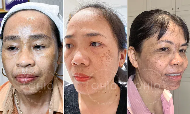 Trị nám da tại Đà Nẵng phòng khám da liễu OHIO