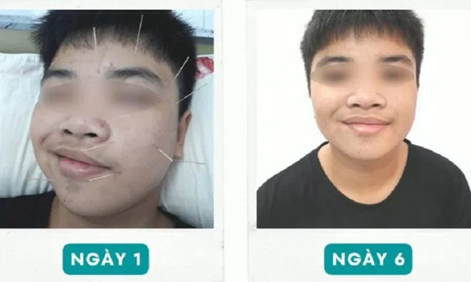 Nam sinh lớp 10 liệt nửa mặt vì trúng "khẩu nhãn oa tà"