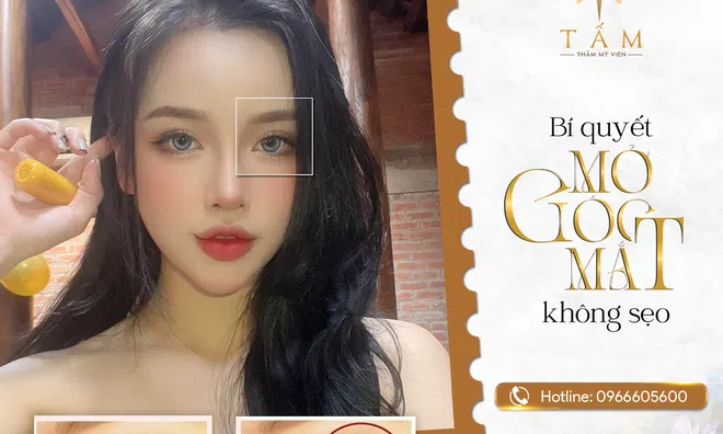 Mở góc mắt tại Thẩm mỹ viện Tấm có để lại sẹo không?