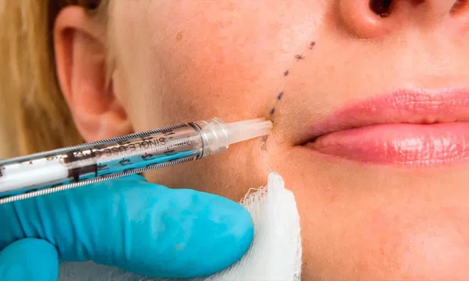 Cô gái tá hỏa thấy mặt phình như quả bóng sau khi tiêm filler môi