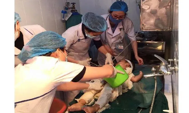 Dùng nước mắm và rượu chữa bỏng, bé trai 31 tháng tuổi bị nhiễm trùng nặng