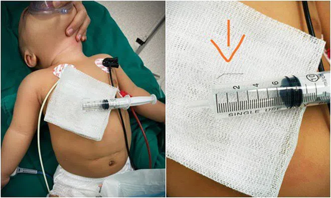 Mẹ rây cháo để lọt miếng kim loại nhọn khiến con nhập viện cấp cứu