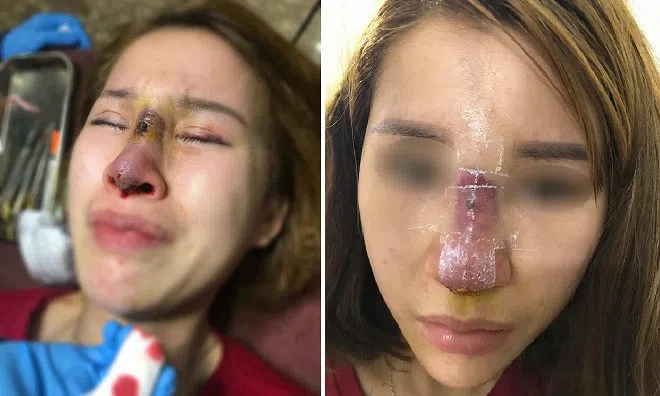 Hàng loạt biến chứng đáng sợ khi phẫu thuật thẩm mỹ, nhìn thôi cũng thấy "đau rụng rời"