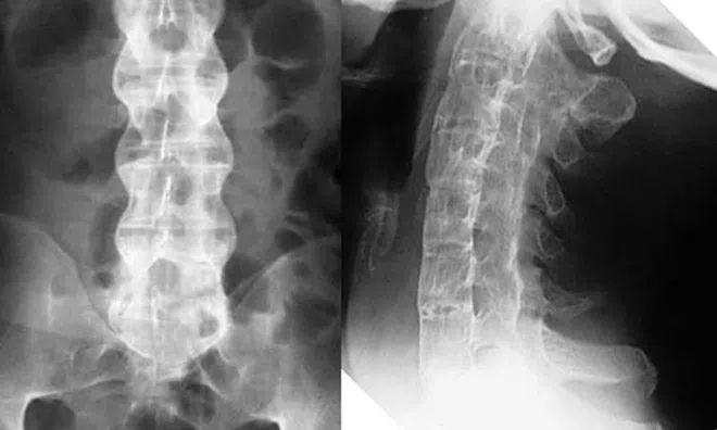 Chữa khỏi bệnh viêm cột sống dính khớp bằng cách tập thể dục tại nhà.