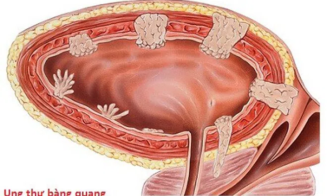 Đau vùng hông thắt lưng chớ có chủ quan bởi đây có thể là dấu hiệu  của ung thư bàng quang