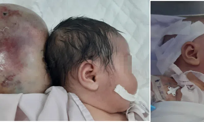 Cấp cứu thành công cho bé sơ sinh mắc tật bẩm sinh thoát vị não