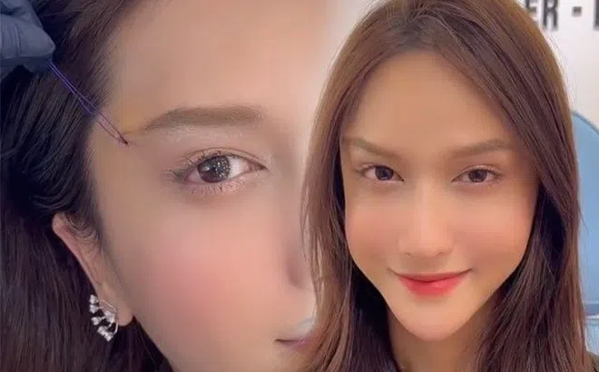 Hot girl đẹp nhất mạng xã hội vừa phẫu thuật mắt, vẻ đẹp ngọc nữ ngày xưa biến mất