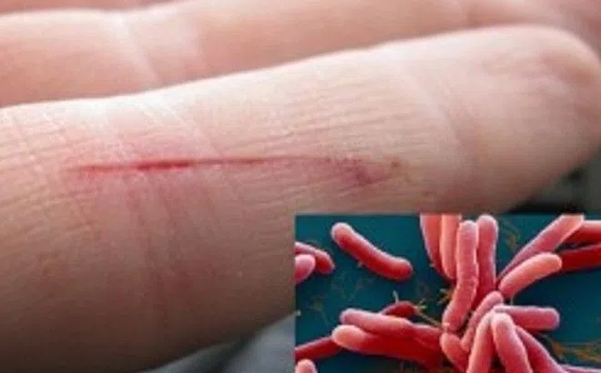 Bé trai Thanh Hóa nhiễm "vi khuẩn ăn thịt người" tử vong trong tình trạng suy đa tạng, hoại tử ruột