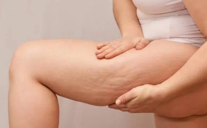 6 thực phẩm vạn người mê khiến da lồi lõm, sần vỏ cam vì mỡ tích chồng chất