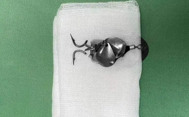 Bé trai bị lưỡi câu móc vào mắt, bác sĩ khuyến cáo tai nạn ít bố mẹ ngờ tới này